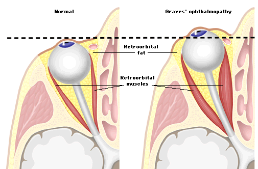 Tireoidna oftalmopatija Tireoidna oftalmopatija