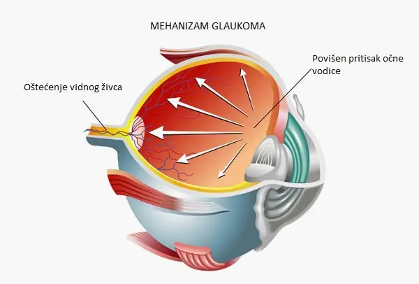 Diagnostics of glaucoma - Everything you need to know about glaucoma - Dr. Ranko Gvozdenović in the show 