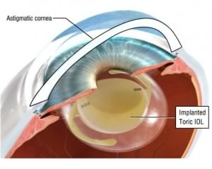 szemlencse beültetés a látásgyakorlási technikák helyreállítása