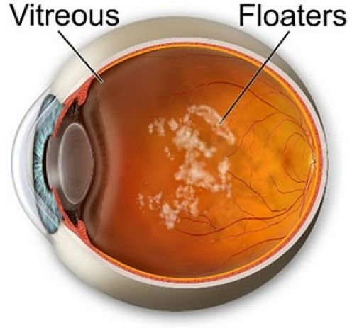 Látóideg-gyulladások - A neuritis retrobulbaris Vak foltok homályos látás