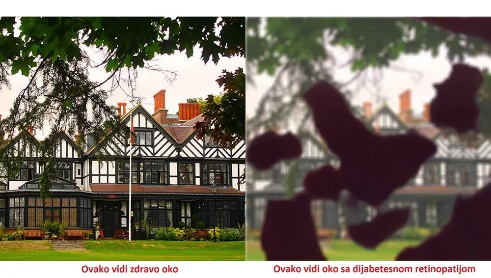 Látás diabéteszes retinopátiával