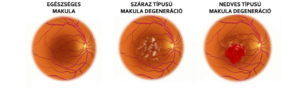 A makula degeneráció száraz és nedves alakja