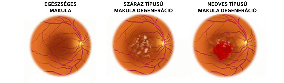 makula látás kezelése