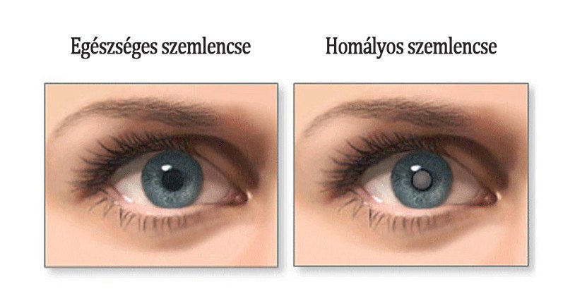 szürkehályog műtét, amikor a látás visszatér miért rossz látás esetén a pupillák kitágultak