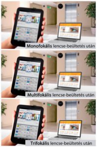 Trifokális lencse beültetés után