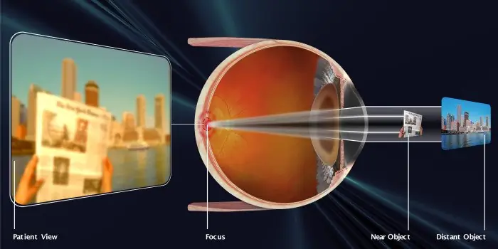 Szürkehályog műtét - Egy Bijeljina-operált beteg tapasztalata