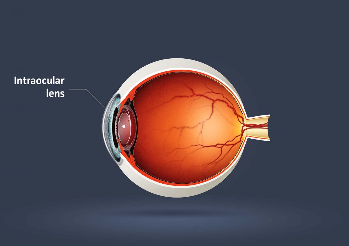intraocular-lenses-1