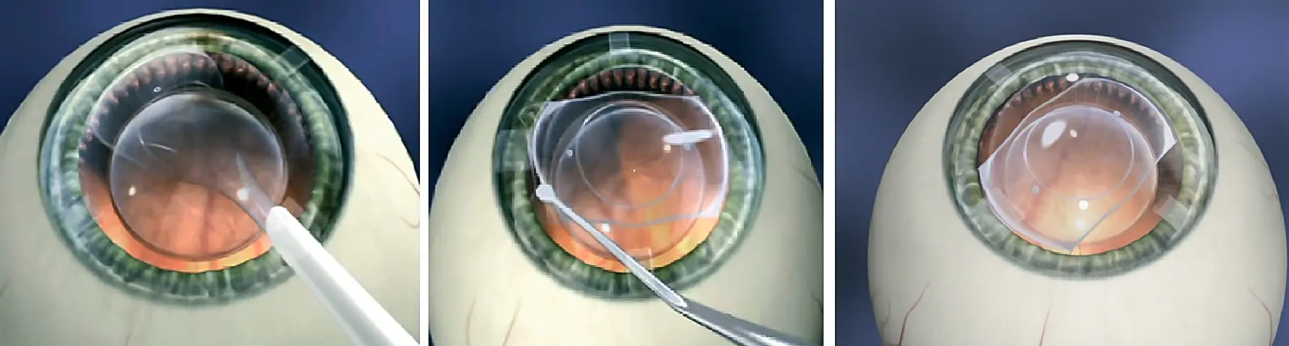 Fakiás lencse beültetésének szimulációja