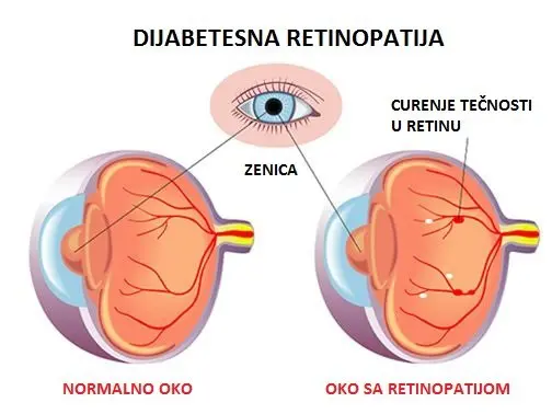 Diabéteszes retinopátia